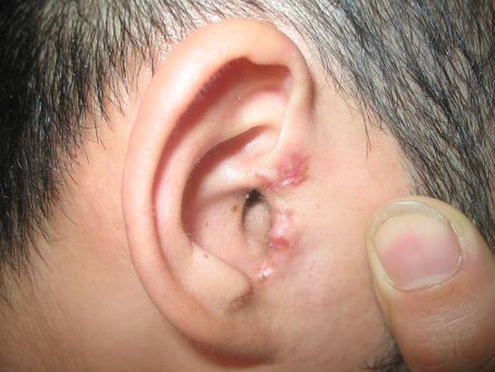 G:\F盘数据\自己的资料\2010_04_21鼓室成型术后图片\100_0050.JPG